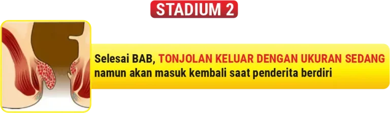 Ilustrasi Wasir stadium 2