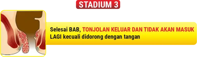 Ilustrasi Wasir stadium 3