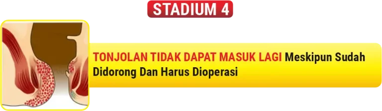 Ilustrasi Wasir stadium